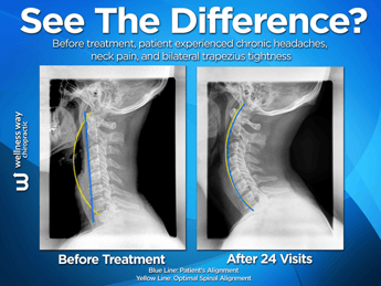 Before_and_After_Chiropractic_Treatment2.png